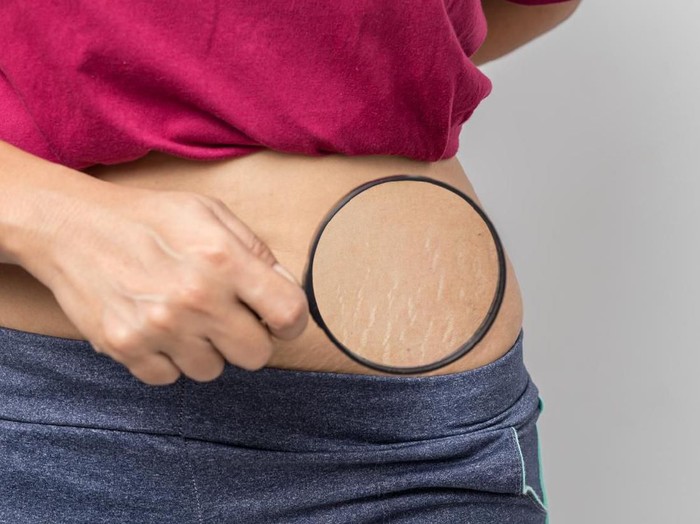 11 Cara Menghilangkan Stretch Mark Dengan Alami Dan Efektif