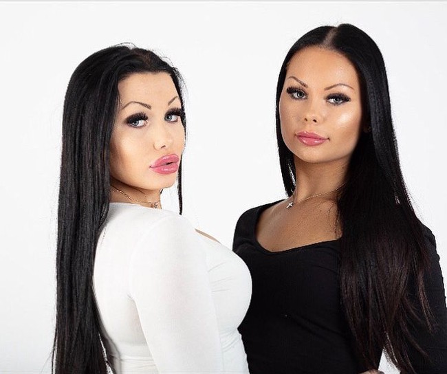 Julia dan Sofia sudah bersahabat sejak usia 10. Dua sahabat yang berasal dari Stockholm itu sudah mulai saling mengubah diri lewat filler di bagian bibir, pipi dan dagu sejak usia 18.  Foto: Instagram