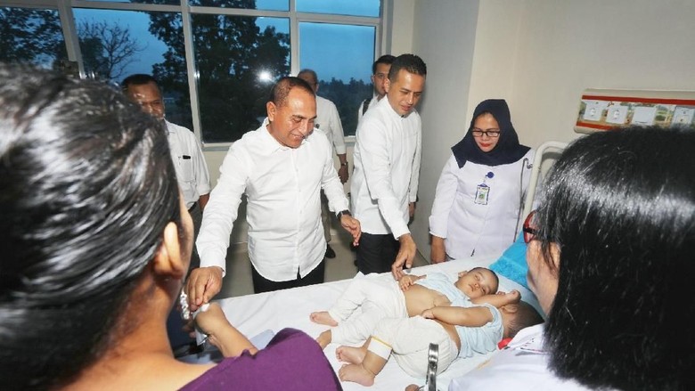 Gubernur Edy Sempat Stres Pikirkan Operasi Kembar Siam Adam-Malik Gubernur Edy Sempat Stres Pikirkan Operasi Kembar Siam Adam-Malik