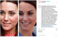 Kate Middleton Disebut Pakai Botox, Kerajaan Inggris Angkat Bicara