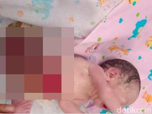 Terlahir dengan Usus di Luar Tubuh, Bayi Arjun Dirawat Intensif di Medan