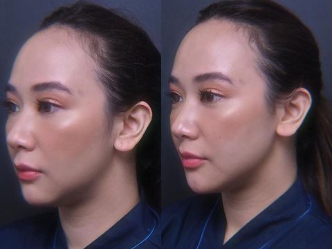 Beauty influencer Putricaya atau Puchh ungkap perawatan botox dan filler. 
