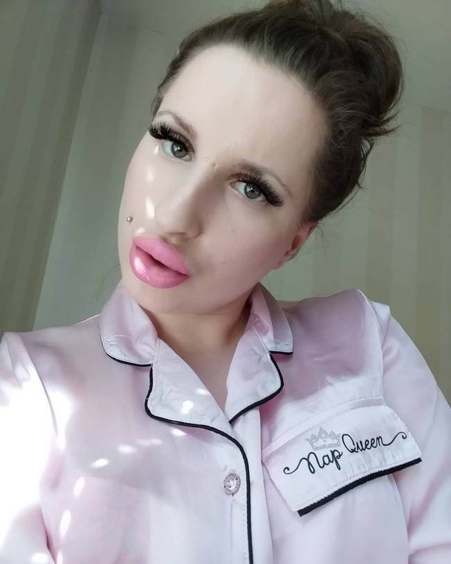 Reaksi positif terhadap bibirnya inilah yang membuat Tamara berani untuk berada di bawah jarum dokter bedah berkali-kali. Prosedur kosmetik yang dijalaninya ini bahkan menelan biaya hampir £ 2.000 atau sekitar Rp 34 juta. Foto: Instagram