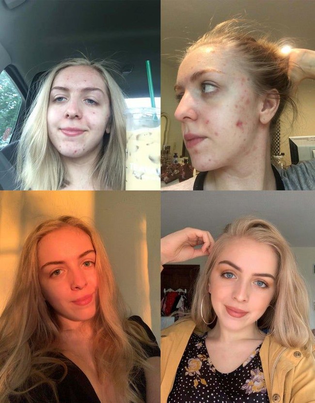  Jerawatan parah saat usia 19 tahun, wanita ini rutin ke dokter kulit. Hanya dalam setahun, wajahnya mulus dan lebih bercahaya. Foto: istimewa/The Brightside/Reddit