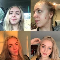  Jerawatan parah saat usia 19 tahun, wanita ini rutin ke dokter kulit. Hanya dalam setahun, wajahnya mulus dan lebih bercahaya. Foto: istimewa/The Brightside/Reddit