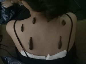 Tidak Perlu Jijik, Terapi Lintah Bisa Atasi Ketergantungan Obat