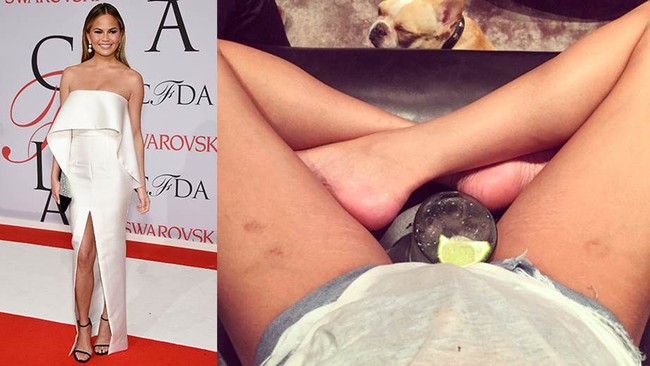 Chrissy Teigen kerap dijuluki sebagai ratunya percaya diri. Istri John Legend itu tak segan memamerkan stretch mark di bagian pahanya.  Foto: Instagram