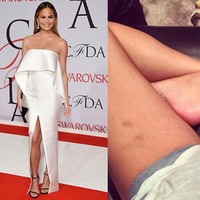 Chrissy Teigen kerap dijuluki sebagai ratunya percaya diri. Istri John Legend itu tak segan memamerkan stretch mark di bagian pahanya.  Foto: Instagram