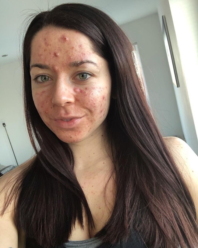 Kunjungan ke dokter pada Februari 2019 mengubah hidup Emily. Dokter tersebut memberikan resep obat minum isotretinoin yang dikombinasikan dengan beberapa produk topikal. Kondisi kulitnya berangsur-angsur membaik dan dalam enam bulan jerawat nanah pun hilang. Foto: Instagram/@emilykeel_