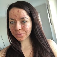 Kunjungan ke dokter pada Februari 2019 mengubah hidup Emily. Dokter tersebut memberikan resep obat minum isotretinoin yang dikombinasikan dengan beberapa produk topikal. Kondisi kulitnya berangsur-angsur membaik dan dalam enam bulan jerawat nanah pun hilang. Foto: Instagram/@emilykeel_