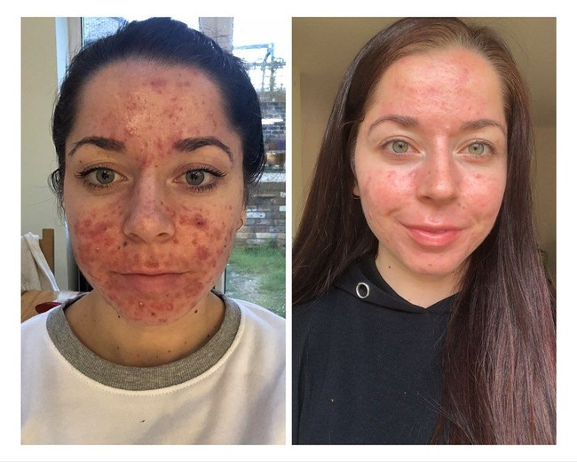 Aku masih tidak percaya hanya berselang waktu enam bulan dari foto pertama (saat mulai berobat) dan terakhir (setelah berobat), ujar Emily, yang mengaku kini jadi jauh lebih percaya diri. Foto: Instagram/@emilykeel_