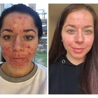 Aku masih tidak percaya hanya berselang waktu enam bulan dari foto pertama (saat mulai berobat) dan terakhir (setelah berobat), ujar Emily, yang mengaku kini jadi jauh lebih percaya diri. Foto: Instagram/@emilykeel_