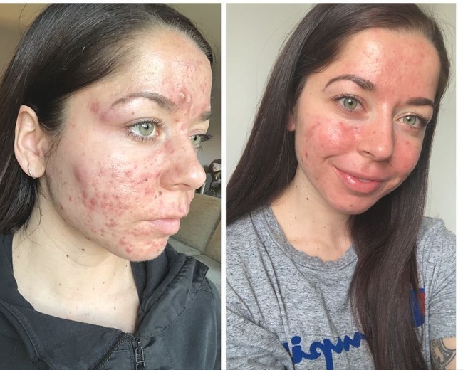 Jerawat parah membuatnya depresi karena merasa tak percaya diri. Aku tidak mau mengajar kelas fitnes lagi, aku tidak mau berada di depan orang-orang. Aku merasa mereka menilai dan berpikir kalau gaya hidupku tidak sehat, jelas Emily, seperti dikutip dari Daily Mail. Foto: Instagram/@emilykeel_