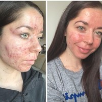 Jerawat parah membuatnya depresi karena merasa tak percaya diri. Aku tidak mau mengajar kelas fitnes lagi, aku tidak mau berada di depan orang-orang. Aku merasa mereka menilai dan berpikir kalau gaya hidupku tidak sehat, jelas Emily, seperti dikutip dari Daily Mail. Foto: Instagram/@emilykeel_