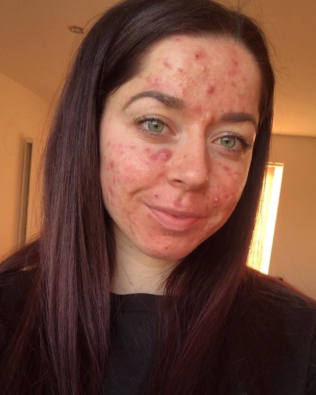 Emily Keel harus hidup dengan jerawat parah penuh nanah selama 13 tahun. Wajah yang dipenuhi jerawat pun membuat kepercayaan dirinya berada di titik terbawah. Foto: Instagram/@emilykeel_