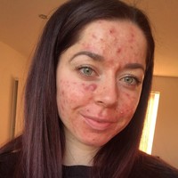 Emily Keel harus hidup dengan jerawat parah penuh nanah selama 13 tahun. Wajah yang dipenuhi jerawat pun membuat kepercayaan dirinya berada di titik terbawah. Foto: Instagram/@emilykeel_