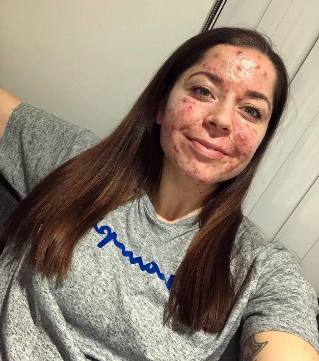 Berbagai dokter kulit sudah pernah ia temui untuk mengobati jerawatnya tapi hasilnya sia-sia. Bahkan ia bercerita pernah ada satu dokter yang bilang bahwa dia belum pernah melihat jerawat separah itu. Foto: Instagram/@emilykeel_