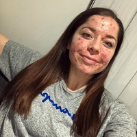 Berbagai dokter kulit sudah pernah ia temui untuk mengobati jerawatnya tapi hasilnya sia-sia. Bahkan ia bercerita pernah ada satu dokter yang bilang bahwa dia belum pernah melihat jerawat separah itu. Foto: Instagram/@emilykeel_