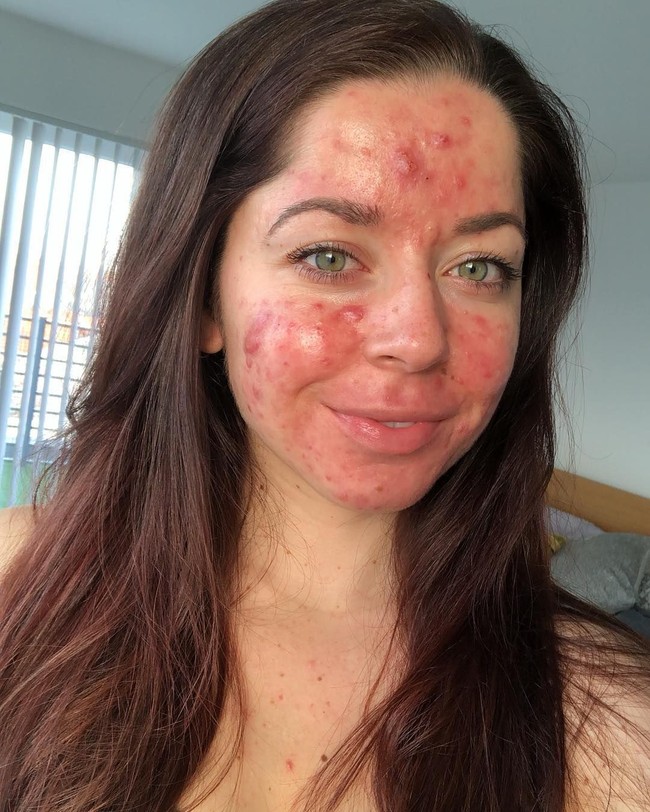 Wanita yang berprofesi sebagai pelatih fitnes ini sudah mencoba berbagai cara untuk mengatasi jerawatnya. Mulai dari terapi sinar, minum antibiotik hingga chemical peeling. Tapi tak ada satupun yang membuat kondisi kulitnya membaik. Foto: Instagram/@emilykeel_