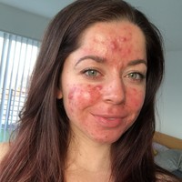 Wanita yang berprofesi sebagai pelatih fitnes ini sudah mencoba berbagai cara untuk mengatasi jerawatnya. Mulai dari terapi sinar, minum antibiotik hingga chemical peeling. Tapi tak ada satupun yang membuat kondisi kulitnya membaik. Foto: Instagram/@emilykeel_