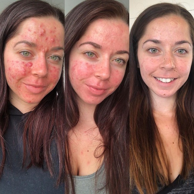 Meskipun masih ada kemerahan di area pipi, hidung dan dagu, tapi jerawat wanita asal Portsmouth, Inggris, tersebut sudah hilang total. Hanya dalam enam minggu kulitnya berubah drastis. Foto: Instagram/@emilykeel_