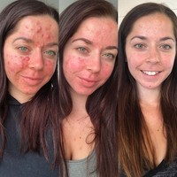 Meskipun masih ada kemerahan di area pipi, hidung dan dagu, tapi jerawat wanita asal Portsmouth, Inggris, tersebut sudah hilang total. Hanya dalam enam minggu kulitnya berubah drastis. Foto: Instagram/@emilykeel_