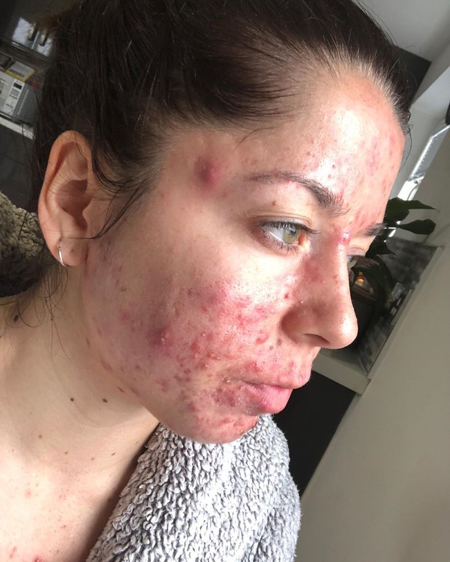 Perawatan dari dalam pun dilakukan. Wanita 25 tahun ini sebisa mungkin menghindari konsumsi gluten dan susu. Namun hasilnya sama saja. Foto: Instagram/@emilykeel_