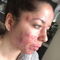 Perawatan dari dalam pun dilakukan. Wanita 25 tahun ini sebisa mungkin menghindari konsumsi gluten dan susu. Namun hasilnya sama saja. Foto: Instagram/@emilykeel_