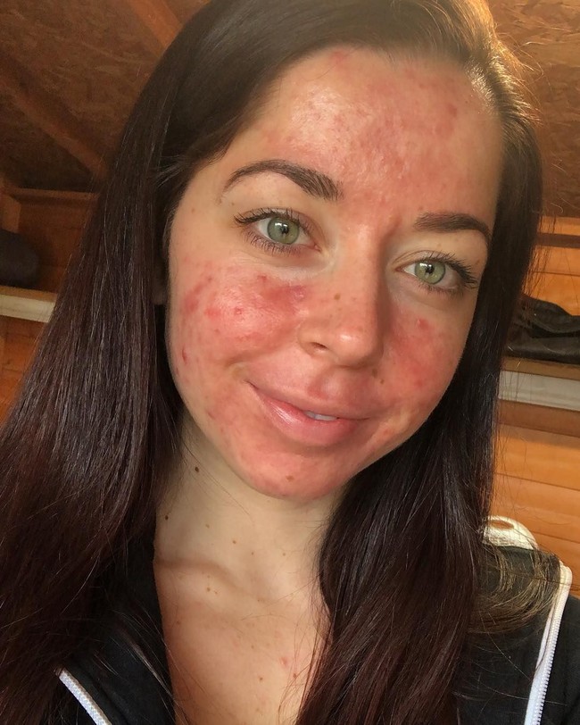 Emily mengalami kondisi yang dinamakan sindrom ovarium polikistik, yakni terganggunya fungsi ovarium pada wanita di usia produktif. Akibatnya hormon Emily tidak seimbang dan makin memperparah kulit yang sudah dipenuhi jerawat nanah. Foto: Instagram/@emilykeel_