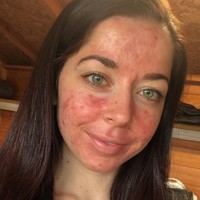 Emily mengalami kondisi yang dinamakan sindrom ovarium polikistik, yakni terganggunya fungsi ovarium pada wanita di usia produktif. Akibatnya hormon Emily tidak seimbang dan makin memperparah kulit yang sudah dipenuhi jerawat nanah. Foto: Instagram/@emilykeel_