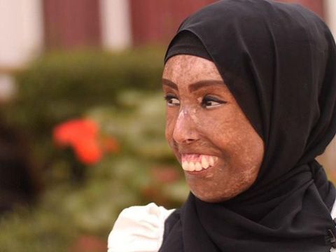 Kisah Inspiratif Farah, Hijabers dengan Wajah Rusak Akibat Scleroderma
