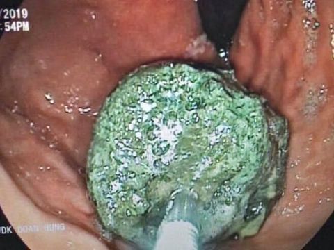 Minum Bubble Tea 3 Kali Sehari, Pria Ini Alami Penyumbatan Usus