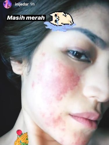 Duh! Alergi Setelah Anestesi Muncul Ruam Merah Besar di Wajah Jessica Iskandar