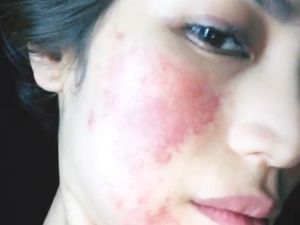 Duh! Alergi Setelah Anestesi Muncul Ruam Merah Besar di Wajah Jessica Iskandar