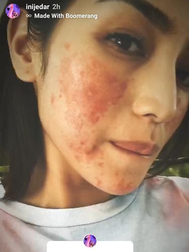 Guys! Jessica Iskandar Minta Tips Sembuhkan Ruam Merah di Wajahnya