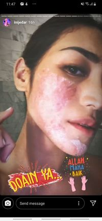 Sudah Lebih Baik, Ini Cara Jessica Iskandar Sembuhkan Alergi di Wajah