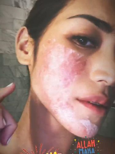 Guys! Jessica Iskandar Minta Tips Sembuhkan Ruam Merah di Wajahnya