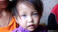 Seorang bocah perempuan berusia 2,5 tahun bernama Amelia Anggraeni, memiliki tiga warna yang dapat berubah-ubah di bola matanya.