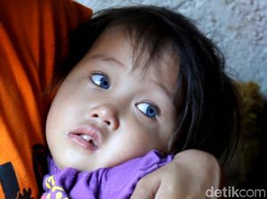 Kata RS Mata Cicendo Soal Mata Bocah Amelia yang Bisa Berubah Warna