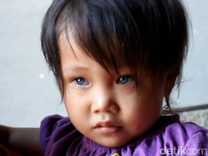 Efek Pembiasan, Bocah dengan Mata Berubah 3 Warna Termasuk Kondisi Langka