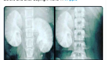 Apa perlu sampai menjual ginjal? Foto: istimewa