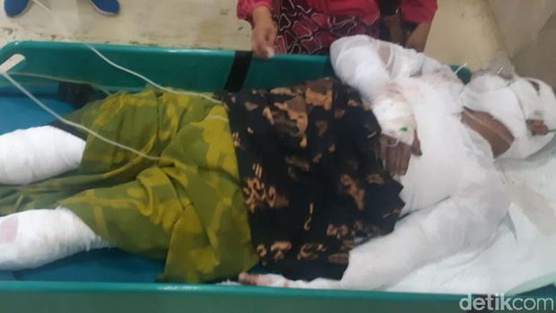 Korban terbakar di sekujur tubuh/