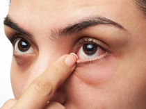 Gejala SePeLe Mata Kering Jangan Disepelekan, Atasi dengan Insto Dry Eyes