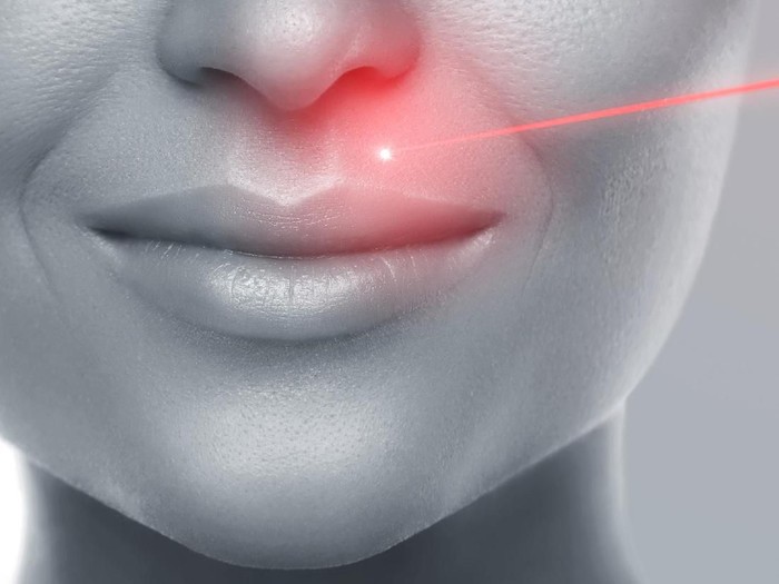 Ilustrasi laser untuk wajah. (Foto: iStock) Ilustrasi laser untuk wajah. (Foto: iStock)