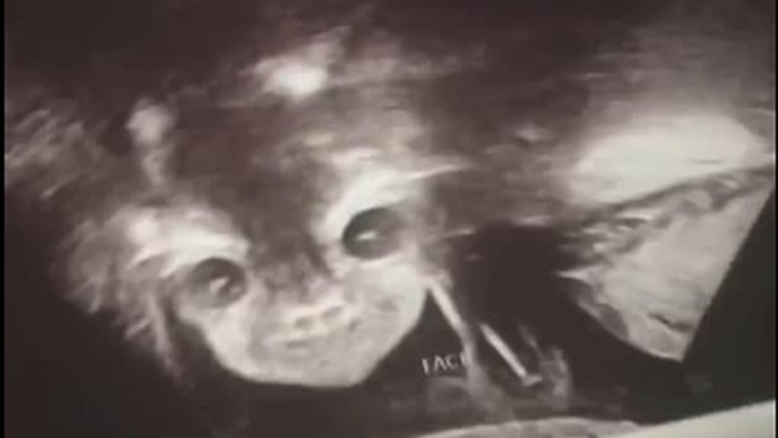 Viral Foto Usg Bayi Disebut Mirip Setan Sang Ibu Tetap Mencintainya
