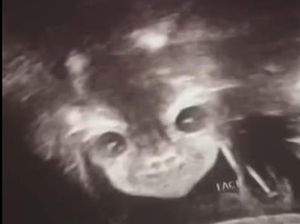 Viral Foto USG Bayi Disebut Mirip Setan, Sang Ibu Tetap Mencintainya