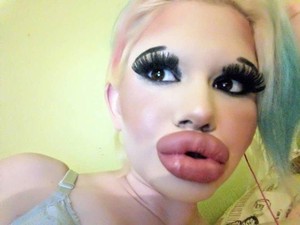 Suntik Filler 15 Kali, Wanita Bulgaria Ingin Punya Bibir Terbesar di Dunia
