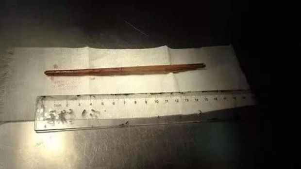 Jatuh Saat Makan Hingga Sumpit Tembus ke Otak, Balita Ini Selamat