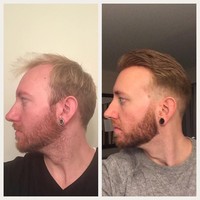 Wig bisa dipasang dan dilepas sendiri di rumah. Caranya dengan mengangkat sebagian wig, lalu bersihkan sisa lem di kulit kepala menggunakan kapas basah. Setelah bersih, cukur rambut-rambut yang tumbuh menggunakan pisau cukur atau cukur listrik. Foto: Instagram/@phildoeshair