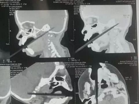 Jatuh Saat Makan Hingga Sumpit Tembus ke Otak, Balita Ini Selamat